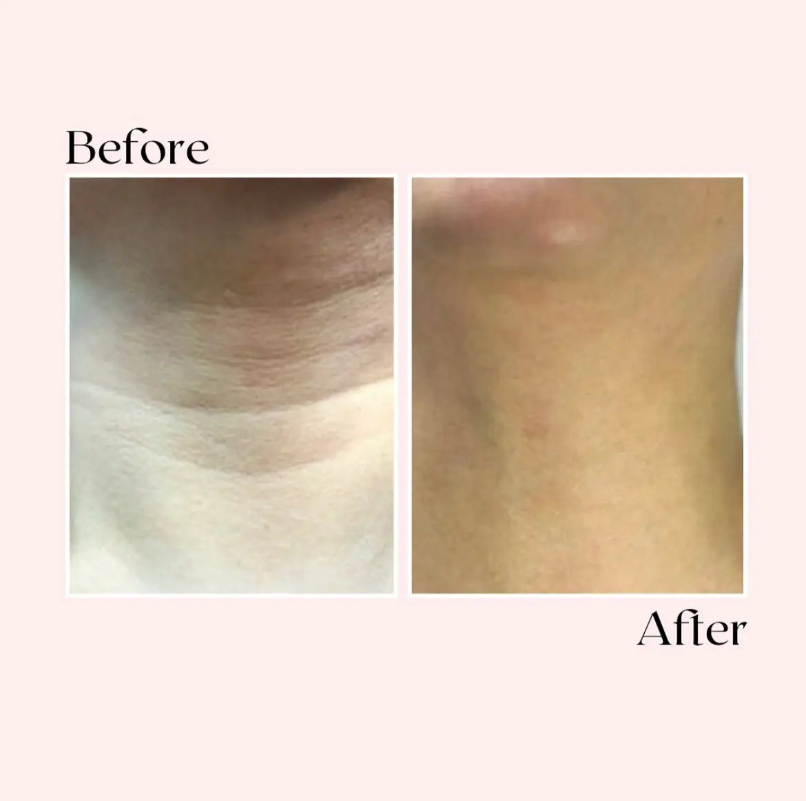 Soin Anti-Âge Microneedle (Coffret 6 pièces)